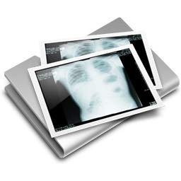 Ngực X Ray